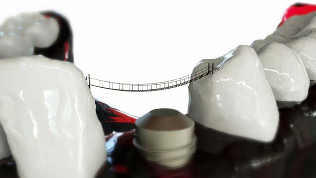 Czy warto wstawiać implanty zębów?