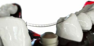 Czy warto wstawiać implanty zębów?