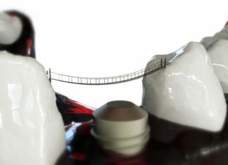 Czy warto wstawiać implanty zębów? Czy warto wstawiać implanty zębów?